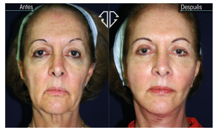 rejuvenecimiento mujer mayor