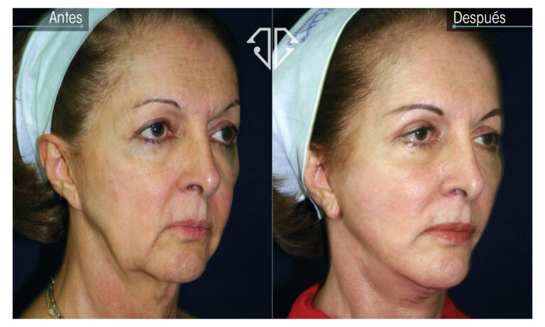 rejuvenecimiento mujer mayor