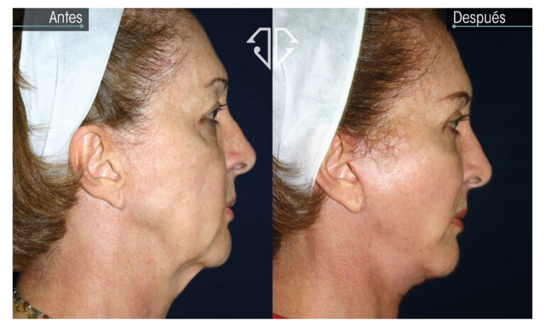 estiramiento facial mujer mayor