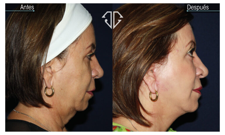 1 casos pag web facelift clasico_Mesa de trabajo 1 copia 14