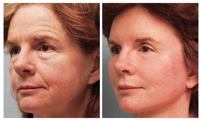 caso antes y despues estiramiento facial de plano profundo