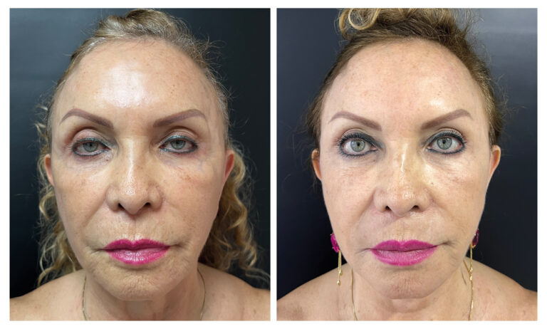 caso antes y despues estiramiento facial de plano profundo