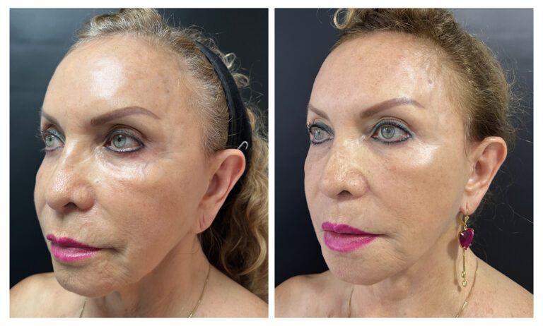 caso antes y despues estiramiento facial de plano profundo