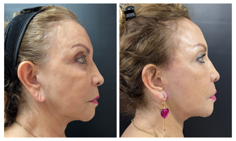 caso antes y despues estiramiento facial de plano profundo