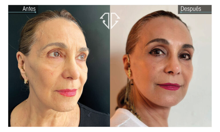 caso antes y despues deep plane facelift 2