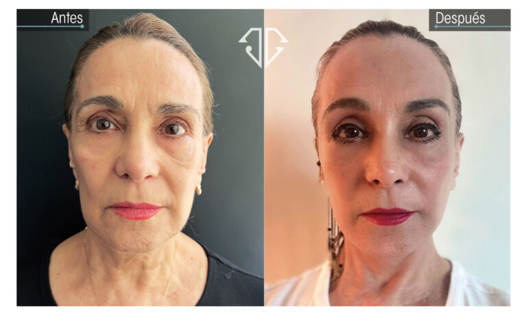 caso antes y despues deep plane facelift