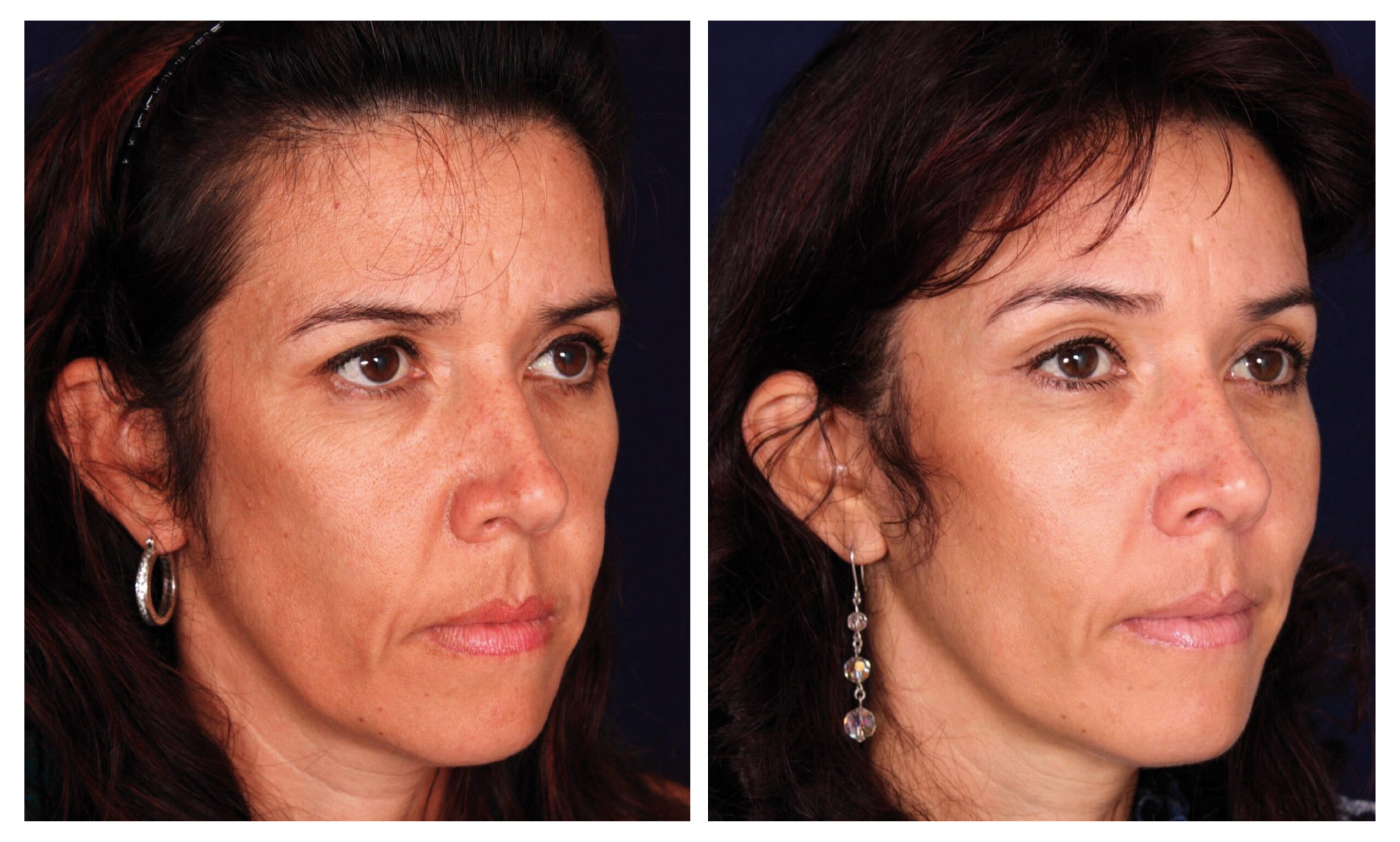 caso antes y después estiramiento facial endoscópico