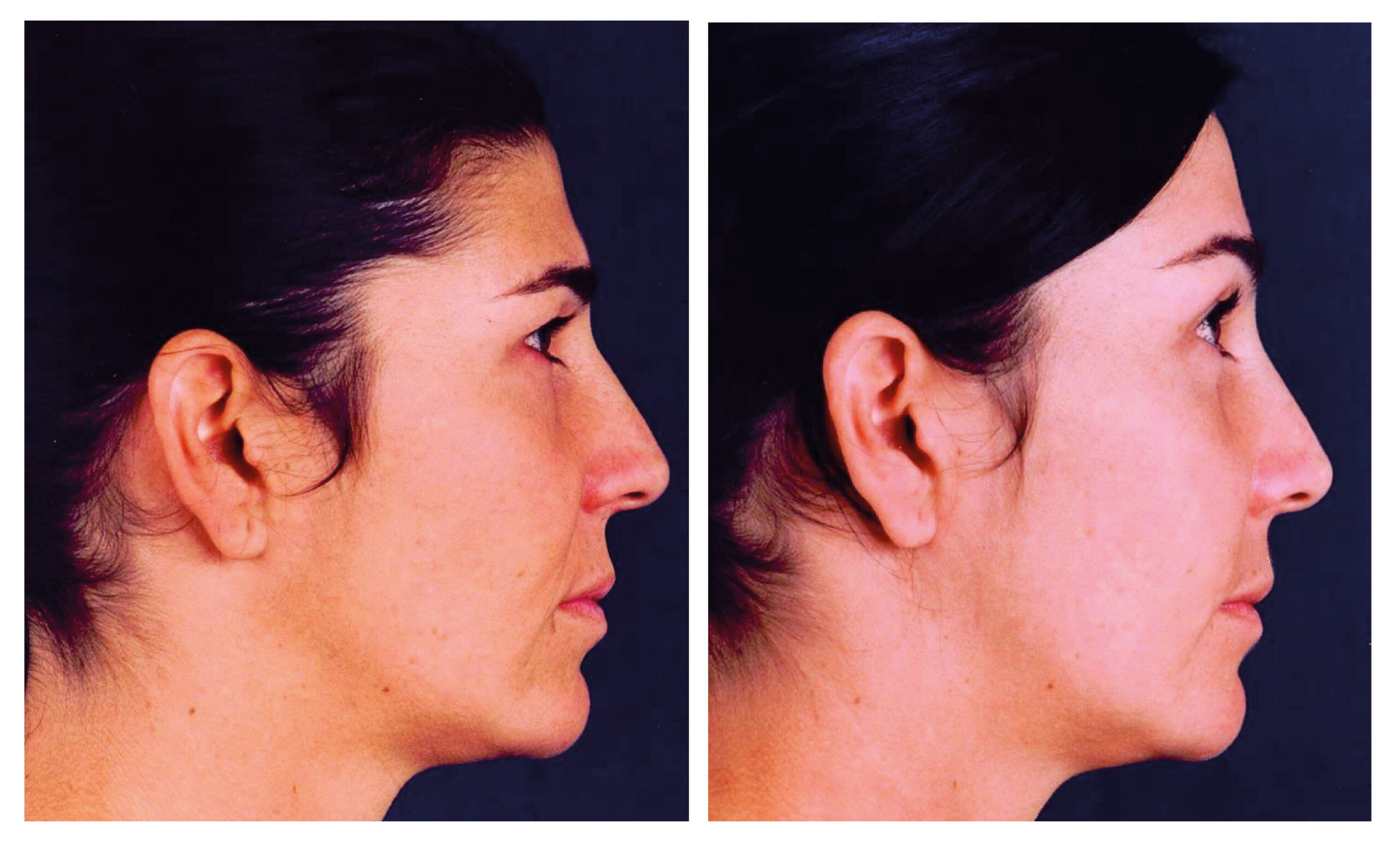 caso antes y después estiramiento facial endoscópico