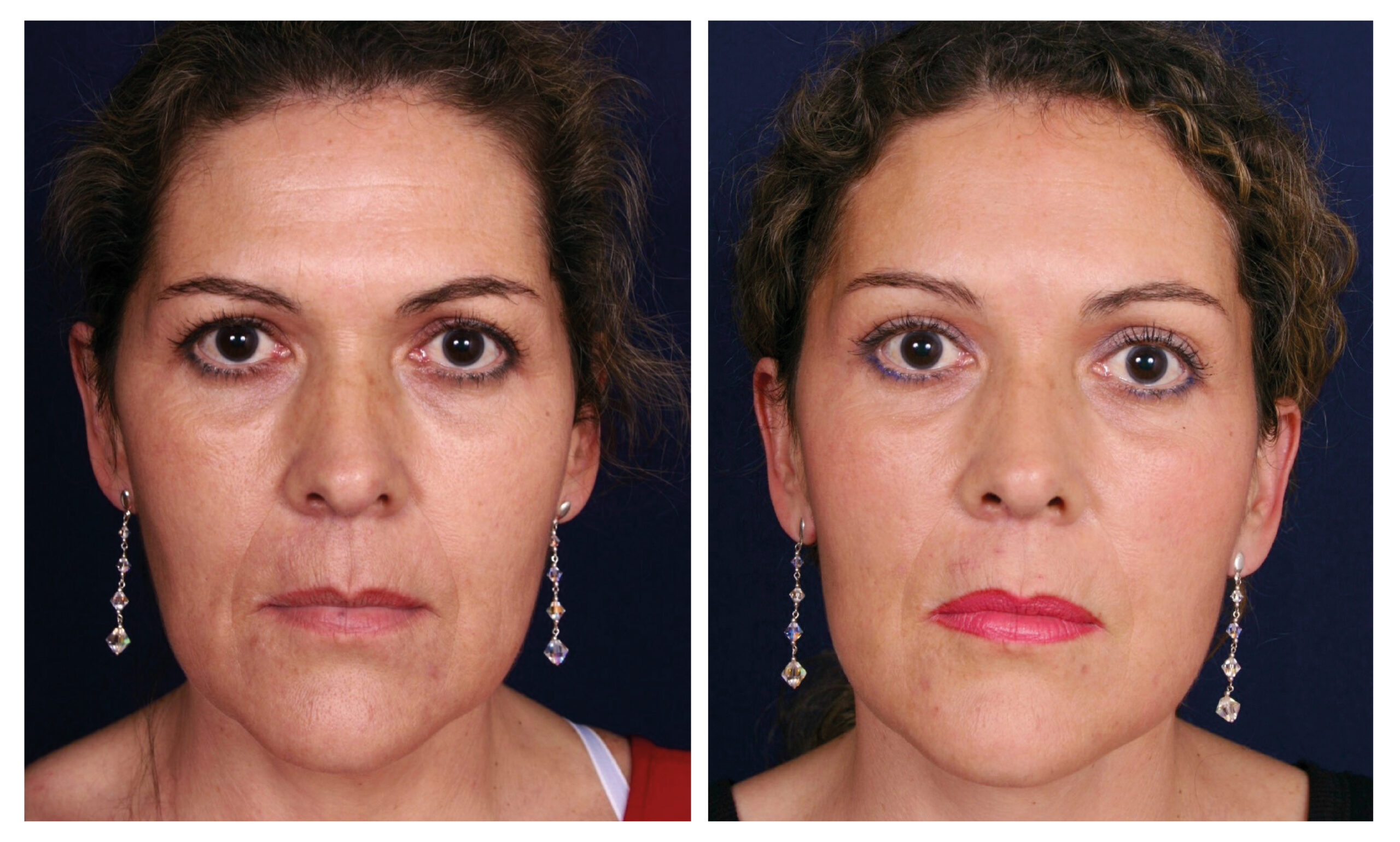 caso antes y después estiramiento facial endoscópico