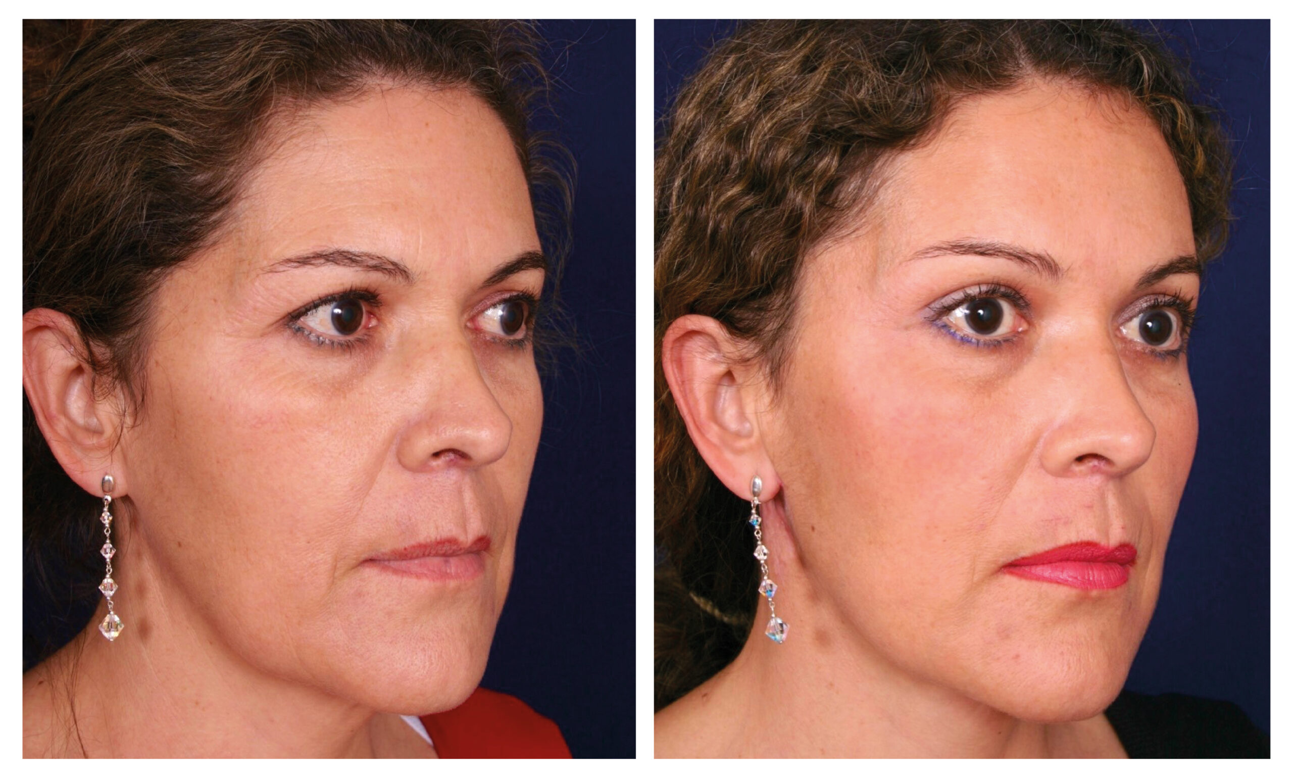 caso antes y después estiramiento facial endoscópico