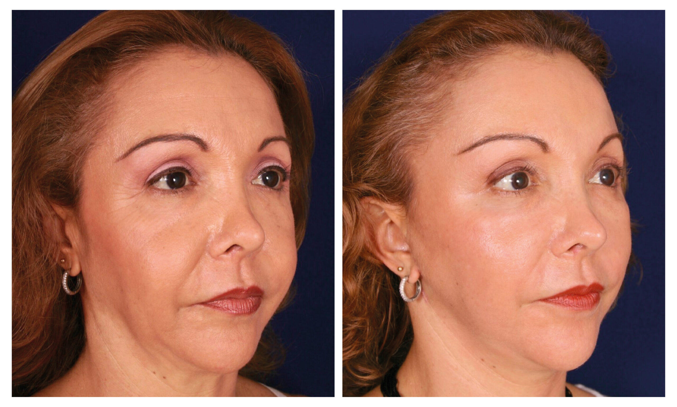 caso antes y después estiramiento facial endoscópico