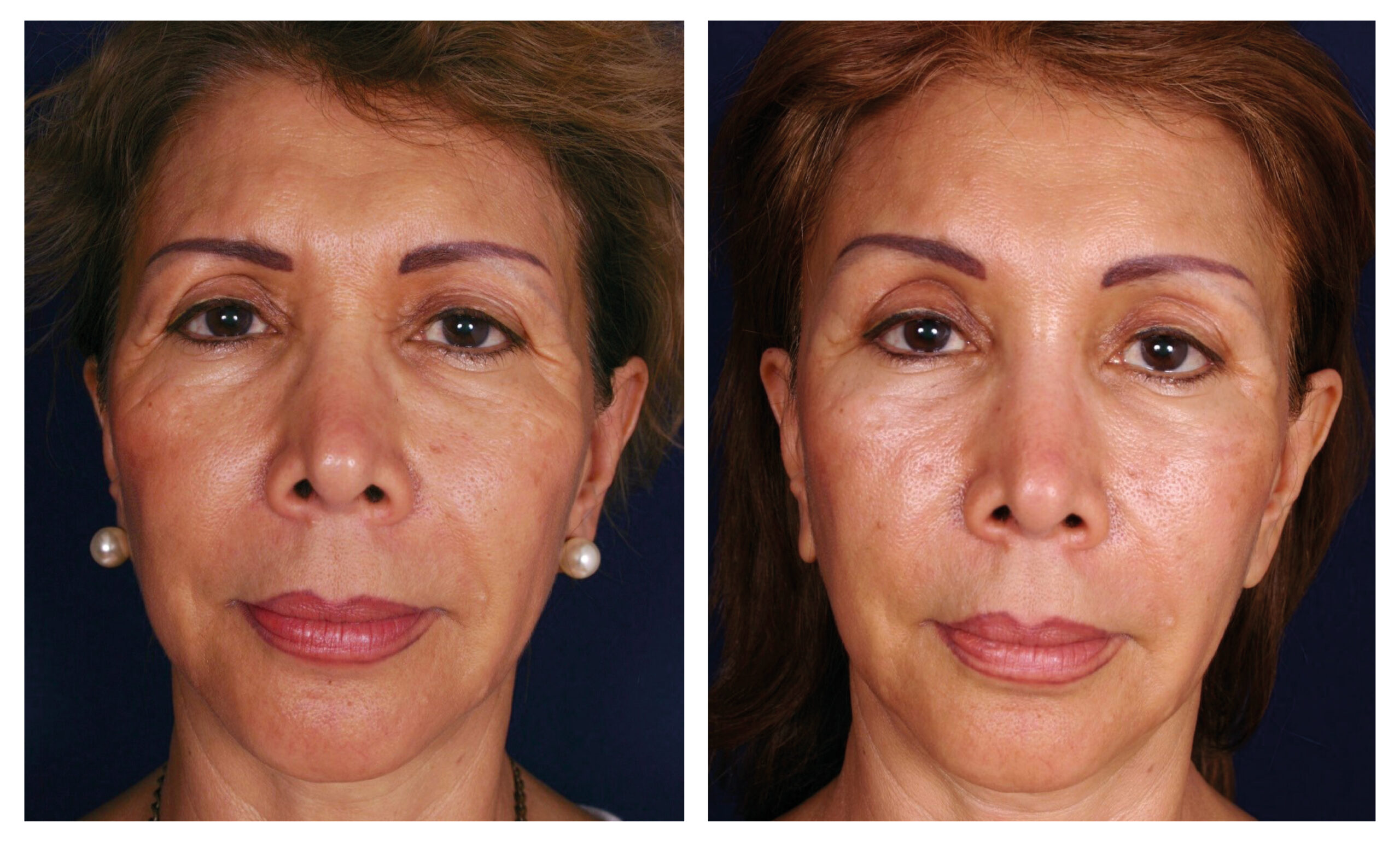estiramiento facial endoscópico