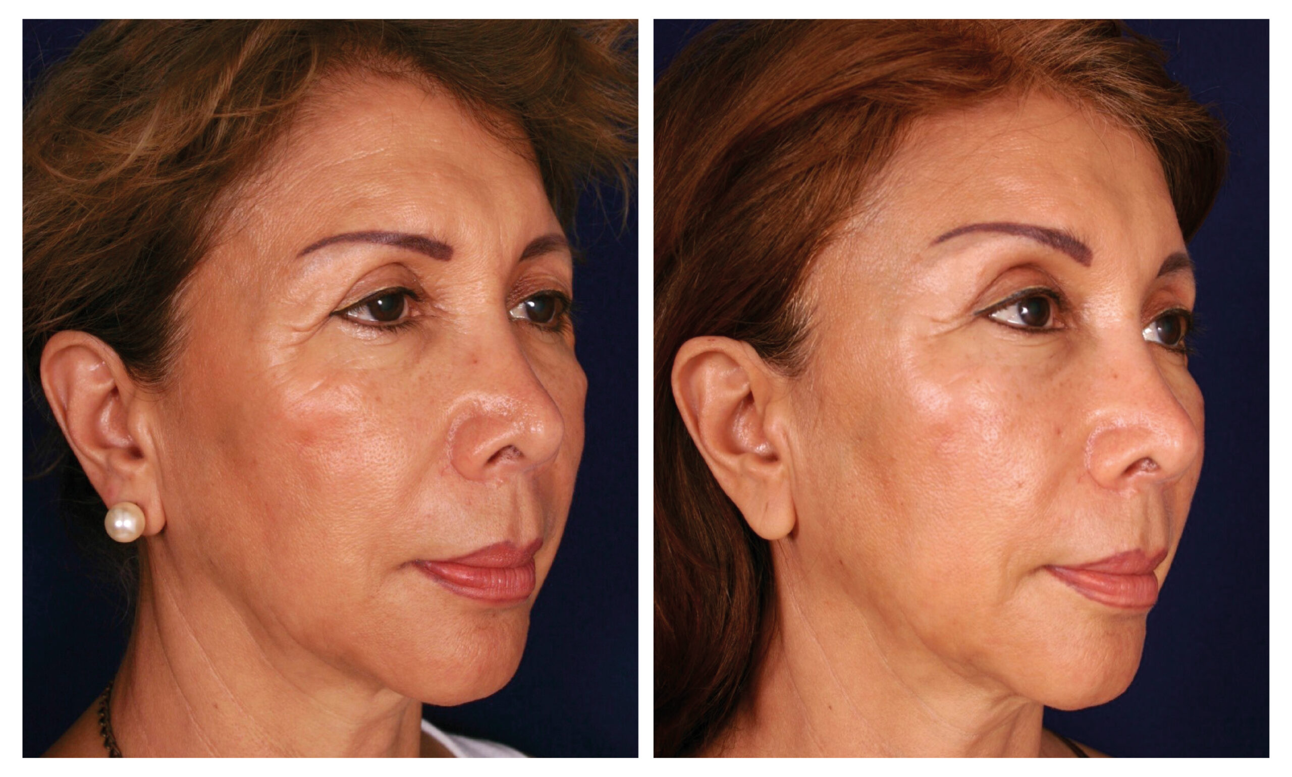 caso antes y después estiramiento facial endoscópico