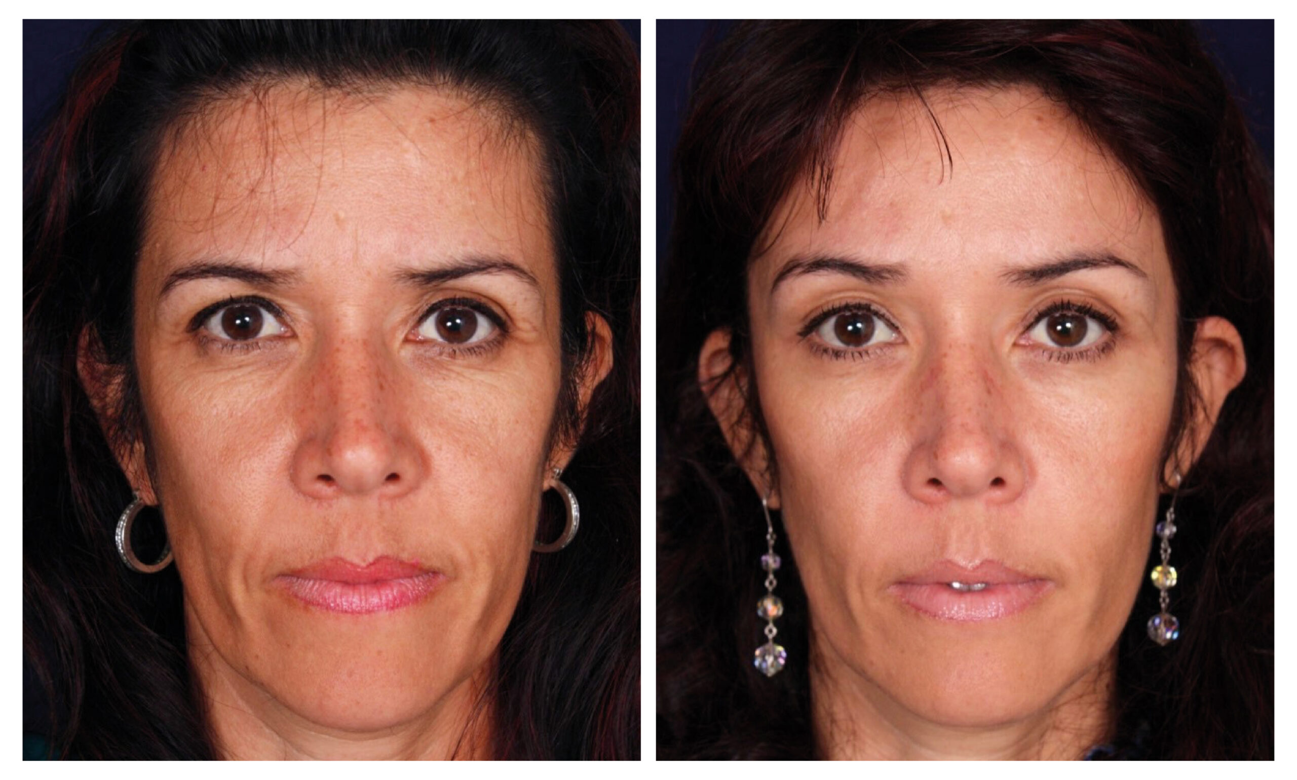 caso antes y después estiramiento facial endoscópico