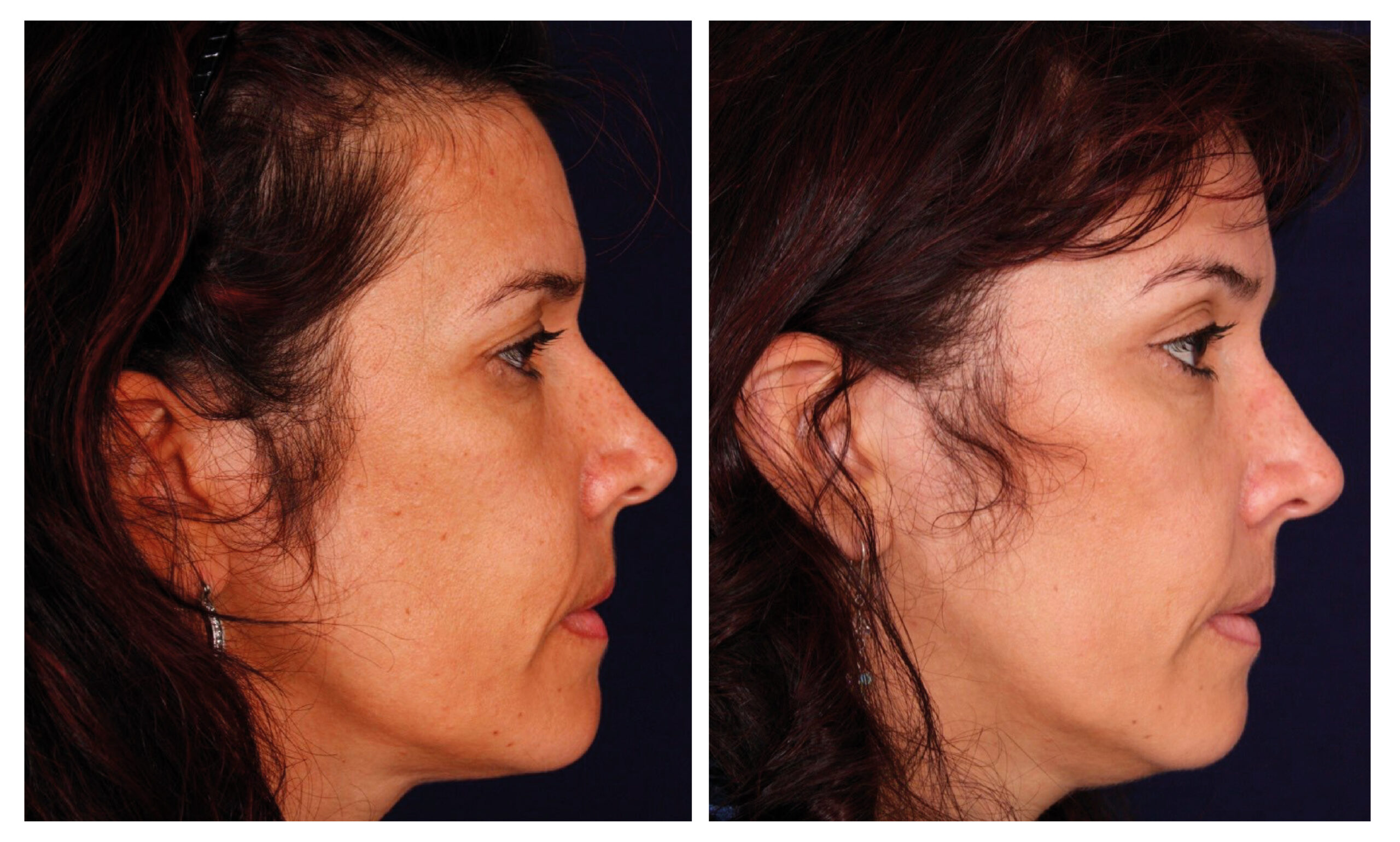 caso antes y después estiramiento facial endoscópico