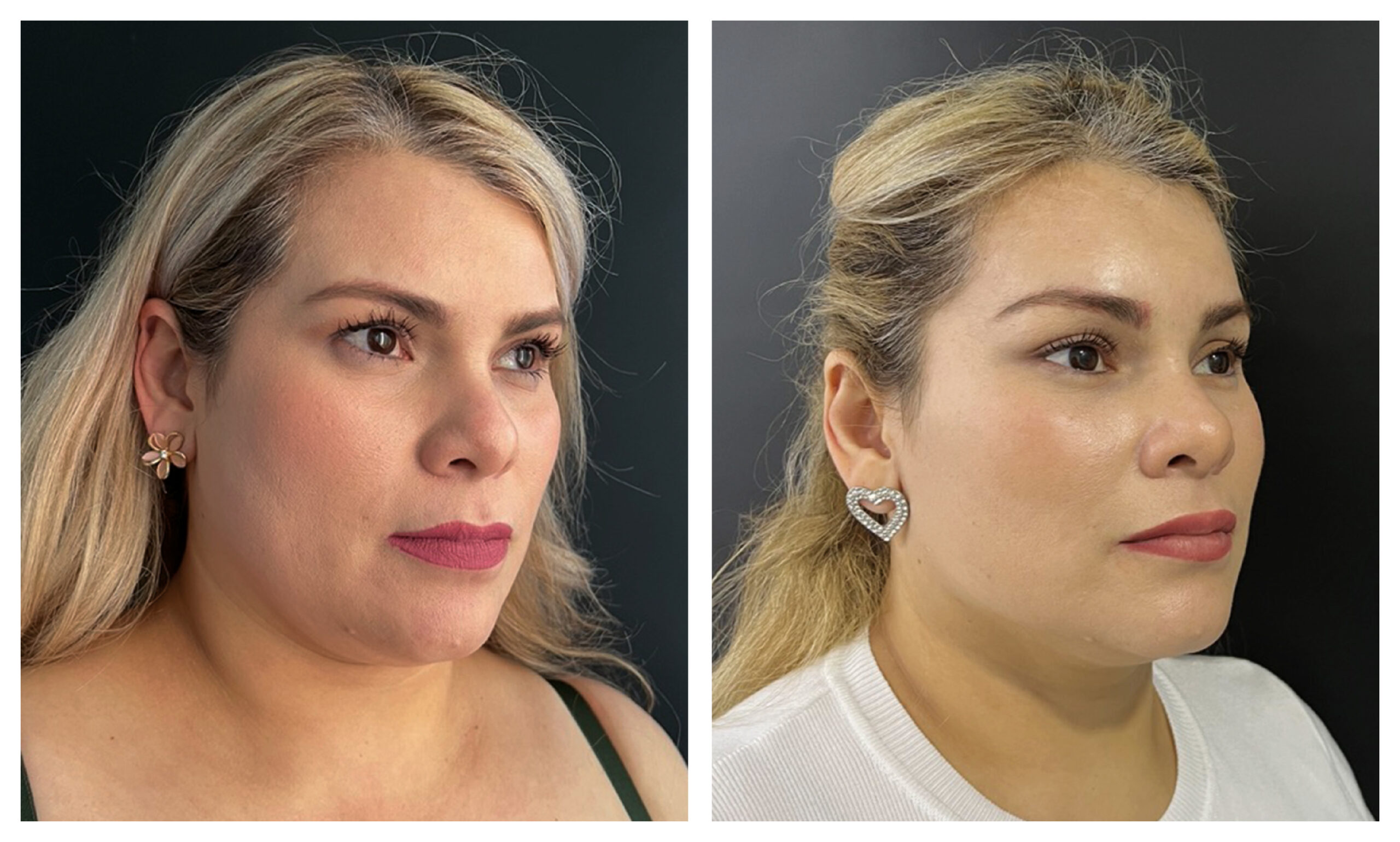 estiramiento facial endoscópico