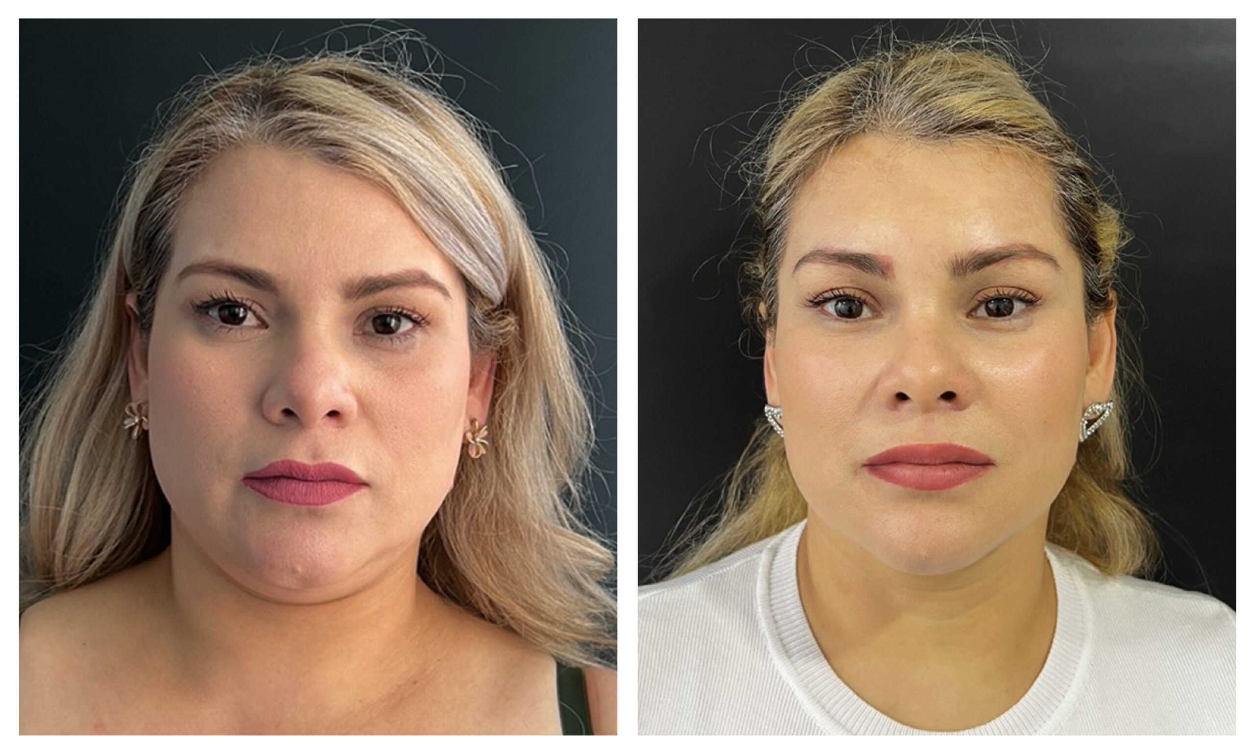 estiramiento facial endoscópico
