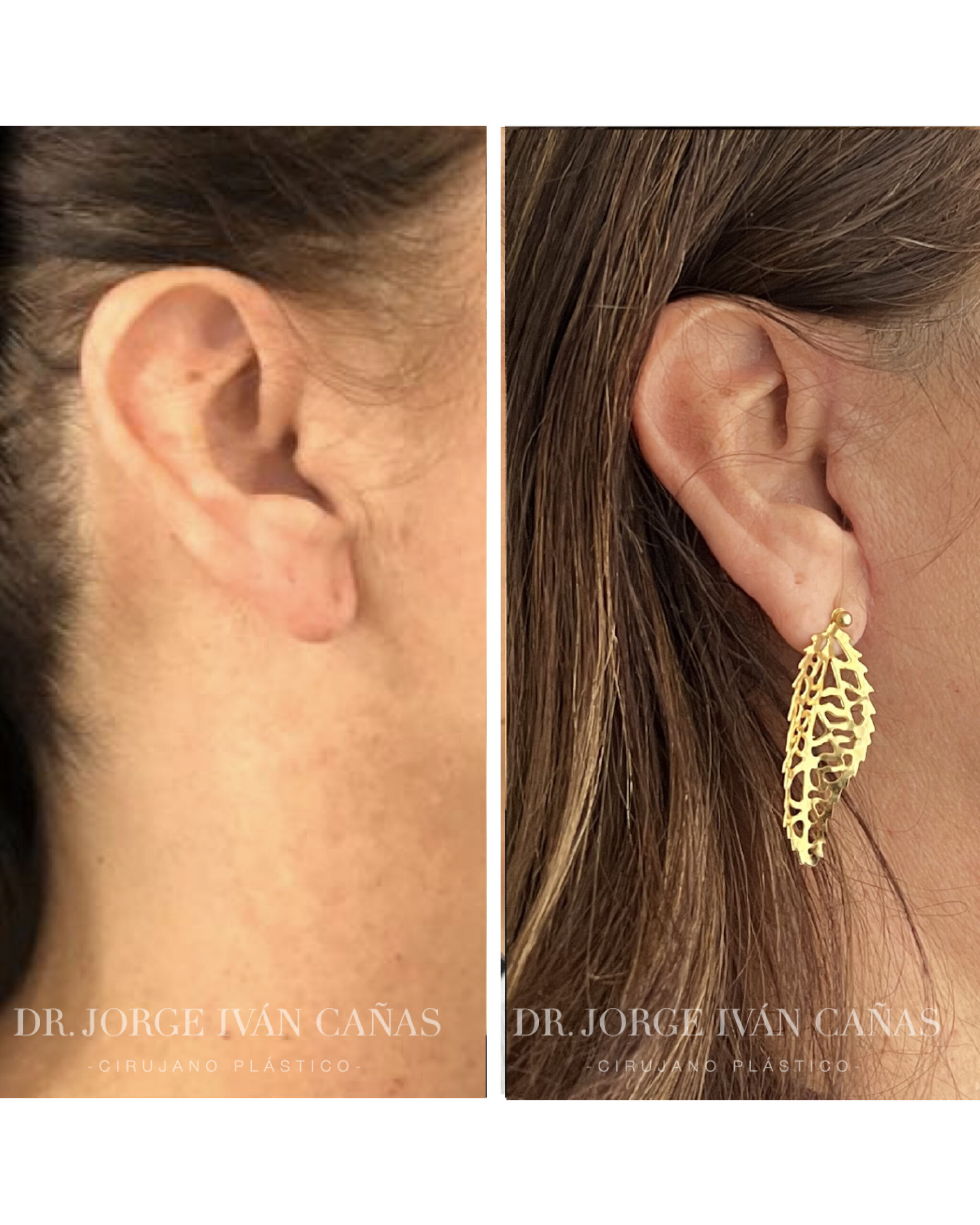 Cicatrices de cirugia facial deep plane