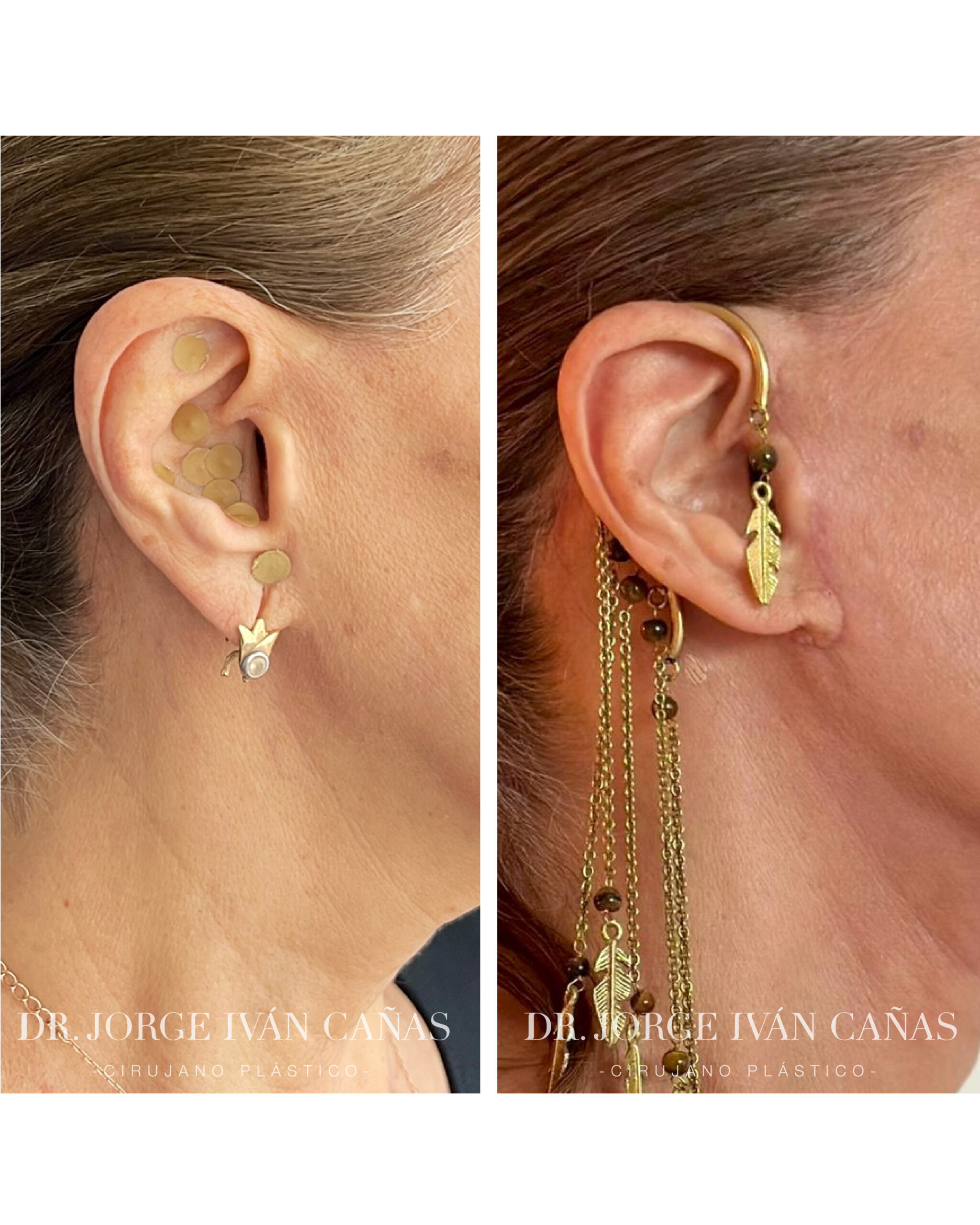 Cicatrices de cirugia facial deep plane