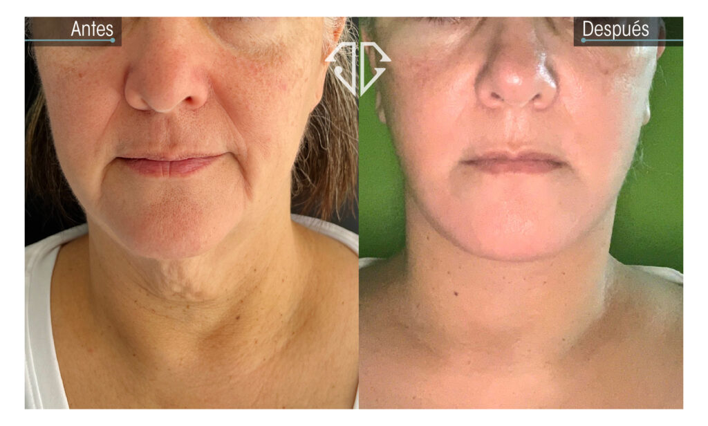 caso antes y despues estiramiento facial de plano profundo