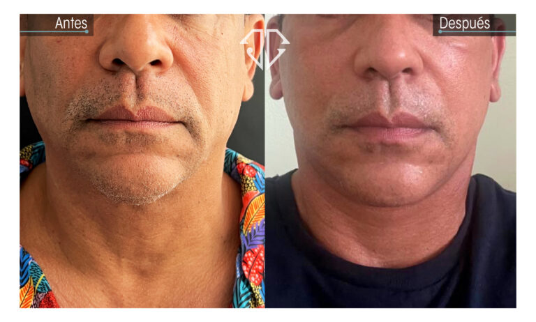 hombre caso facial