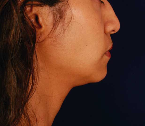 antes y después mentón