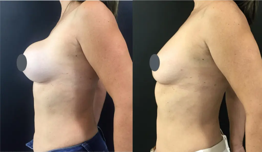 antes y después explantación