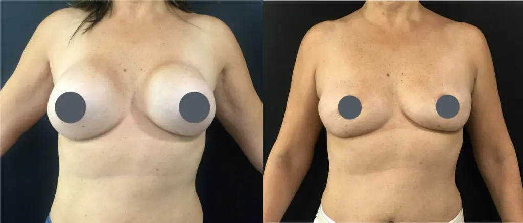 explantación sin cicatrices