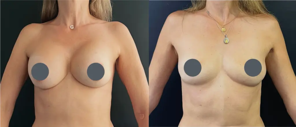 retiro de implamtes mamarios